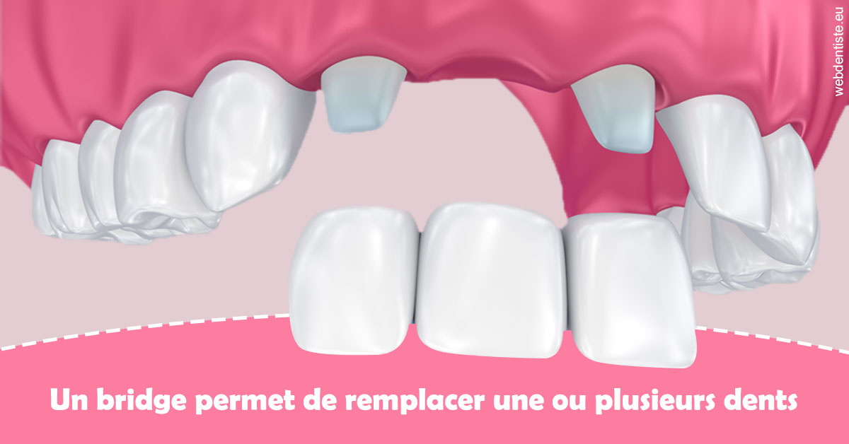https://dr-speisser-jean-michel.chirurgiens-dentistes.fr/Bridge remplacer dents 2