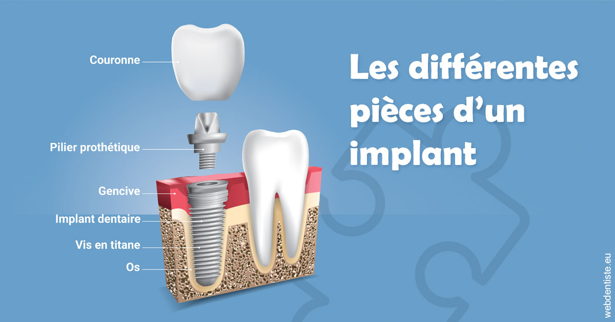 https://dr-speisser-jean-michel.chirurgiens-dentistes.fr/Les différentes pièces d’un implant 1